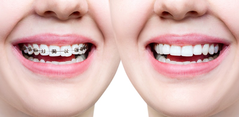 static/img/ServicesProfile/braces.jpg